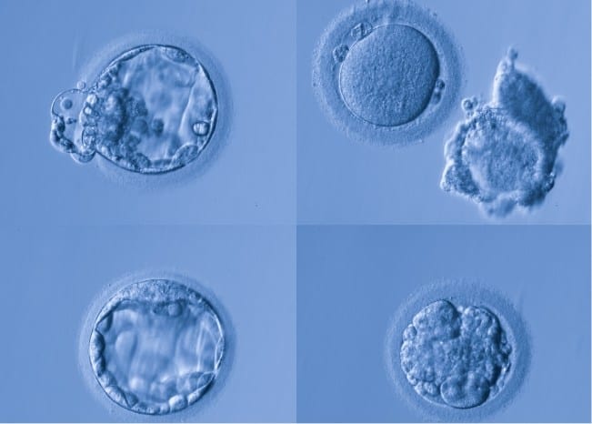 Διαδικασία εξωσωματικής γονιμοποίησης με δωρεά ωαρίων